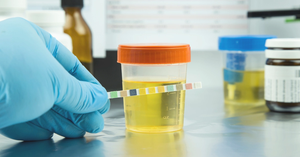 Man holding a sterile urine sample container, commonly used for diagnosing urinary tract infections, prostate issues, or other urological conditions.